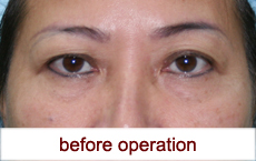 plastic-surgery-blepharoplasty